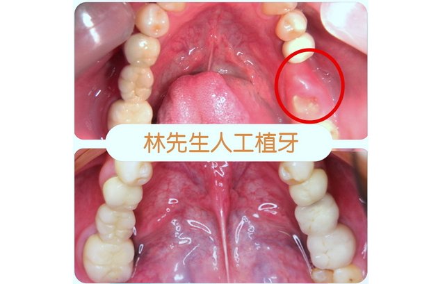 林先生植牙案例   》〉〉深入了解...