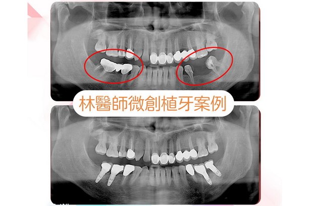 劉先生植牙 案例   》〉〉深入了解...