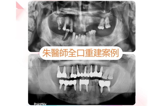 楊伯伯植牙案例   》〉〉深入了解...