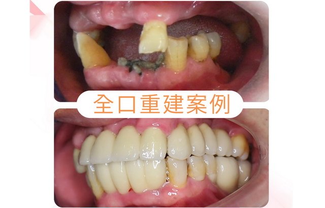 孫先生植牙案例   》〉〉深入了解...