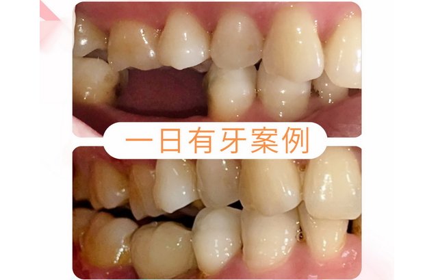 一日有牙 案例   》〉〉深入了解...