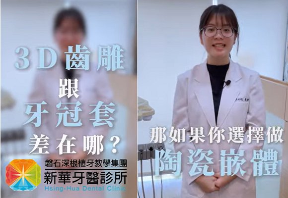 3D齒雕跟牙冠套差在哪？新華謝心耘醫師告訴您