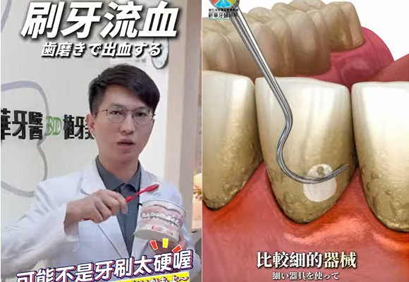 簡碩麟醫師 科普新知EP.2 刷牙會流血其實是牙周病前期徵兆！