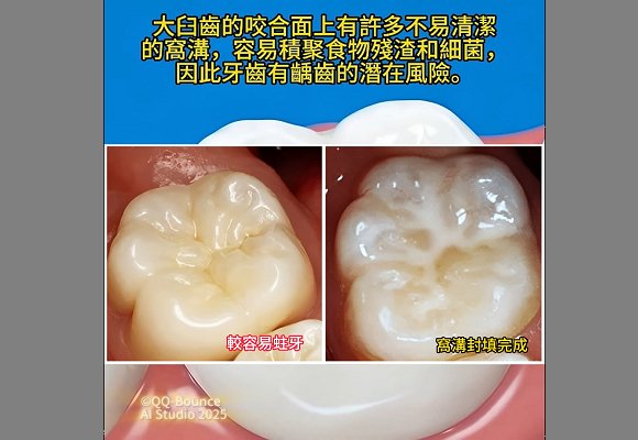 窩溝封填 -- 幫臼齒穿上防彈衣