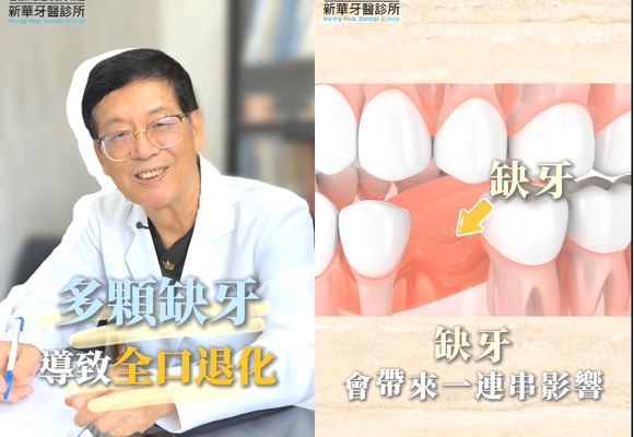 缺牙不只是影響外觀！一不小心連健康牙齒也遭殃？