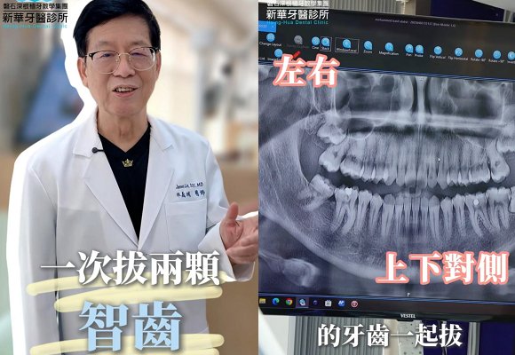 智齒長了兩顆，可以一次拔完嗎？